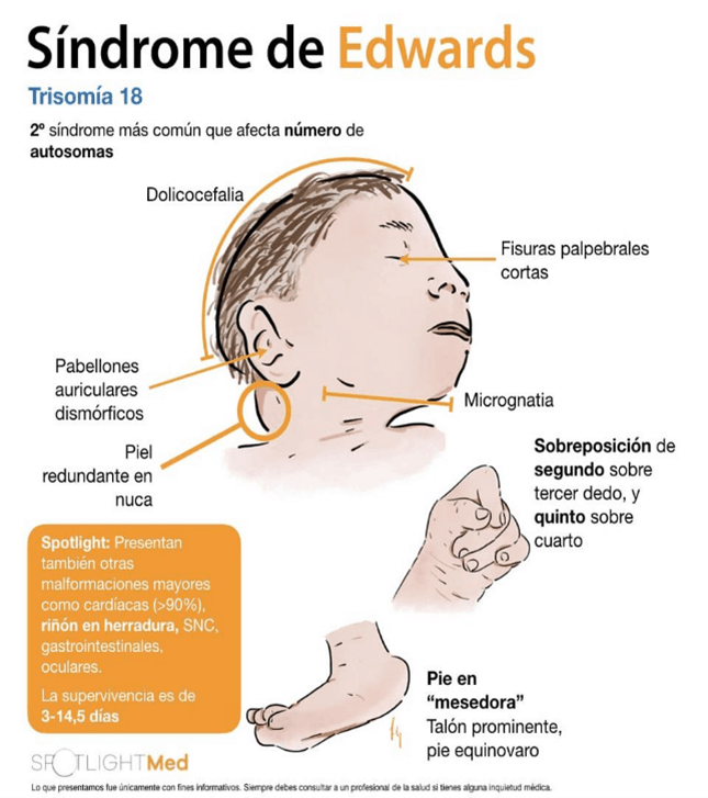 sindrome de edwards