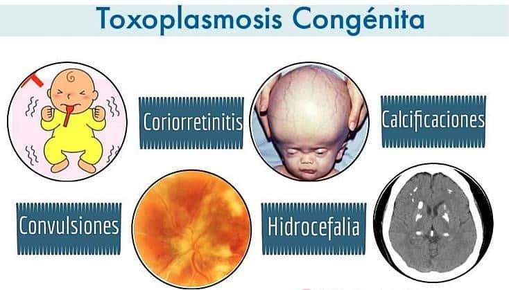 diagnostico de toxoplasmosis congenita