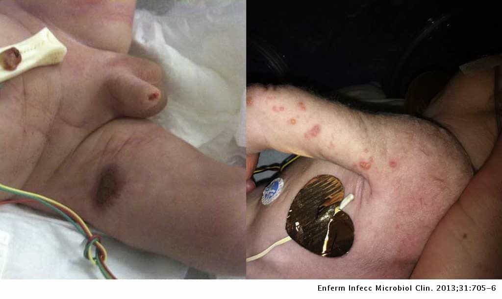 varicela en bebe - congenita